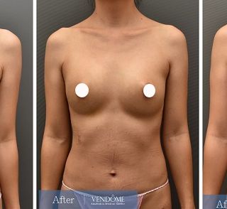 療程效果因人而異，上圖為A罩杯產後女性在做完自體脂肪隆乳之後​手術後一個月、手術後五個月成效